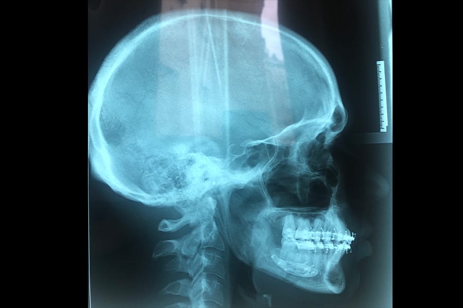 radio apres osteotomie mandibulaire remboursement chirurgie orthognatique dr sandra konopnicki chirurgien maxillo facial stomatologue paris