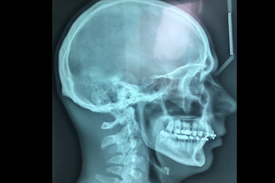 radio avant osteotomie mandibulaire convalescence chirurgie orthognatique docteur sandra konopnicki chirurgien maxillo facial stomatologue paris